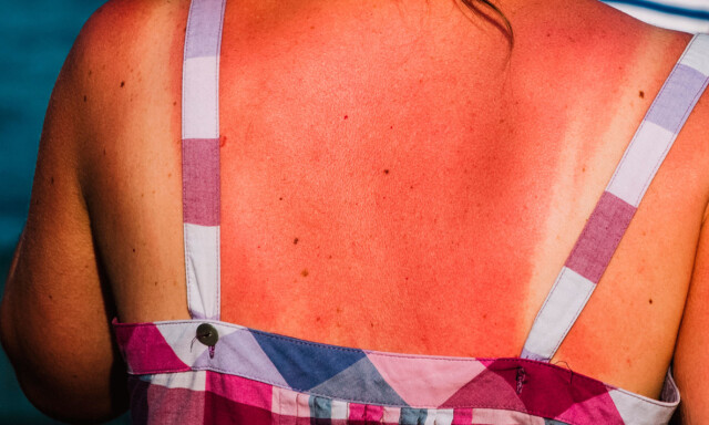 image: Behandling av solskader